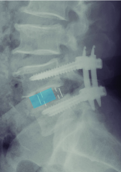 Olif Xray