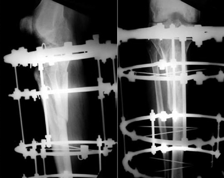 ring type external fixator xray