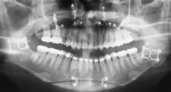 Surgical SAW BLADES XRAY